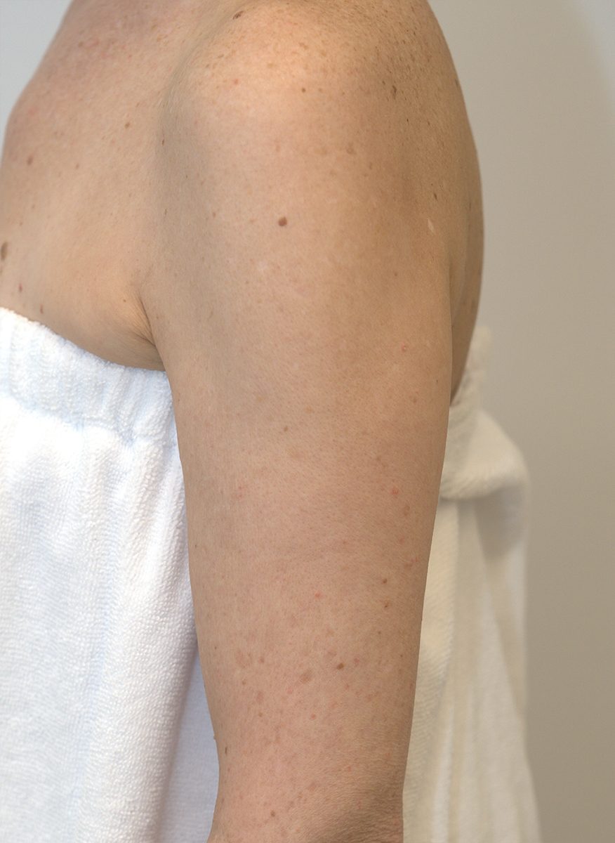 Arm after BBL HEROic treatment