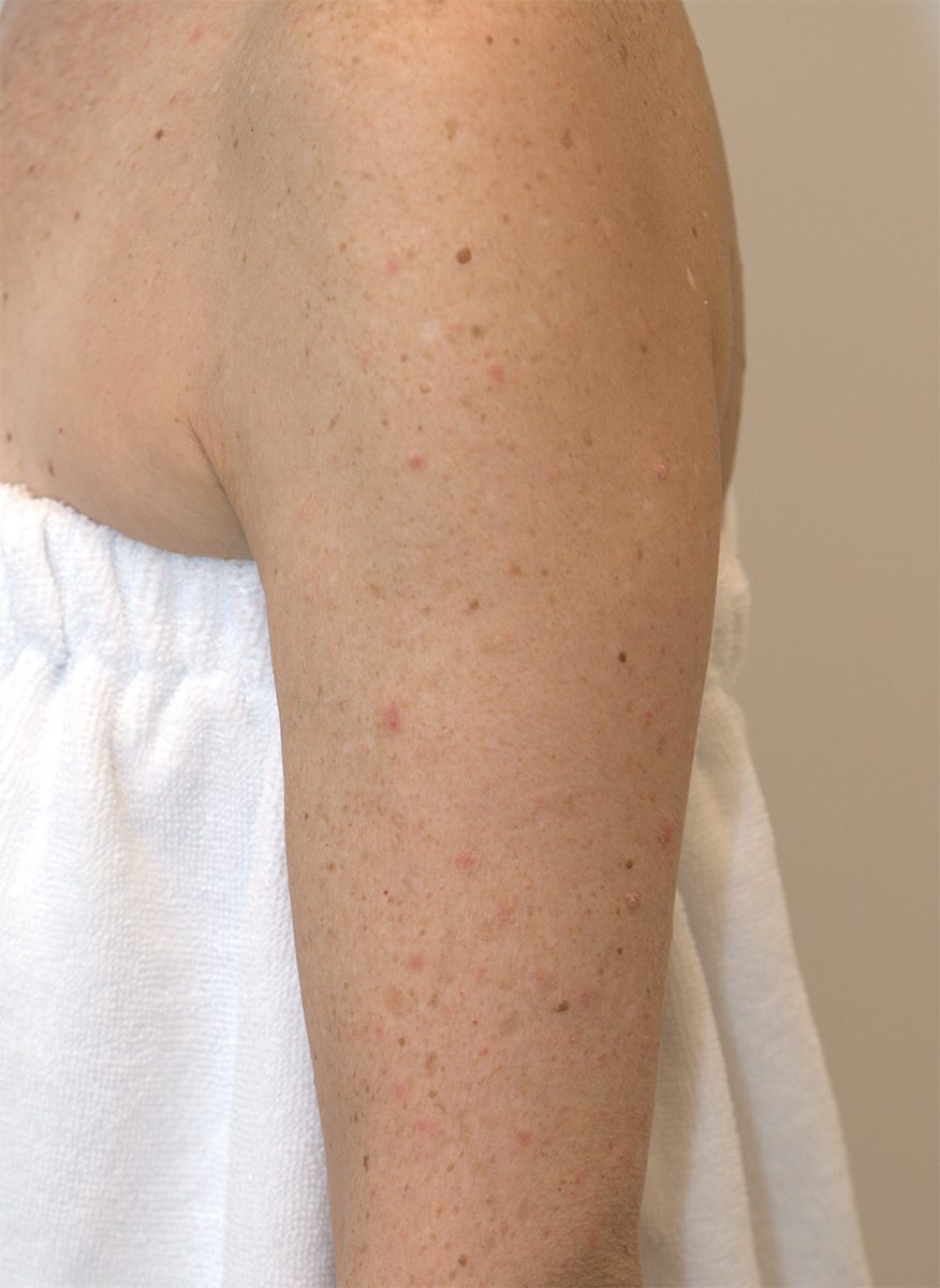 Arm before BBL HEROic treatment