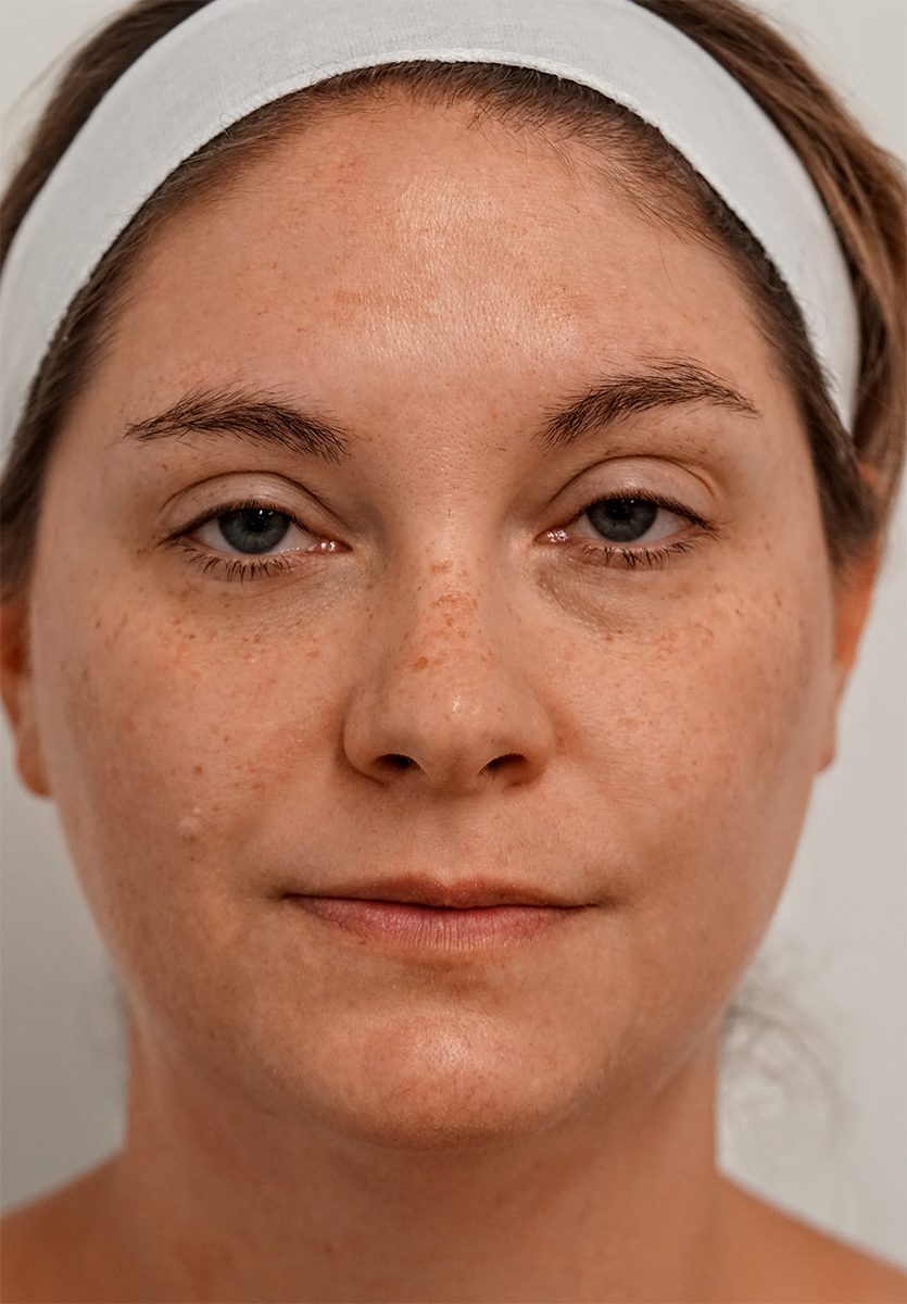 Face before BBL HEROic treatment