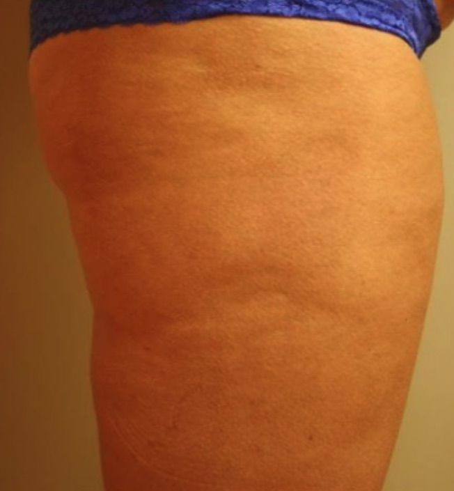 Thigh skin one month after a single HALO treatment