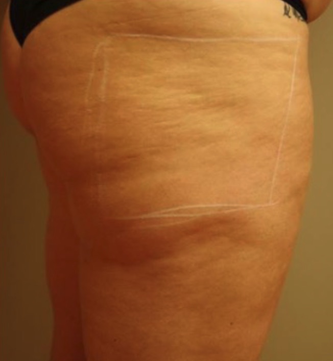 Thigh skin before HALO treatment
