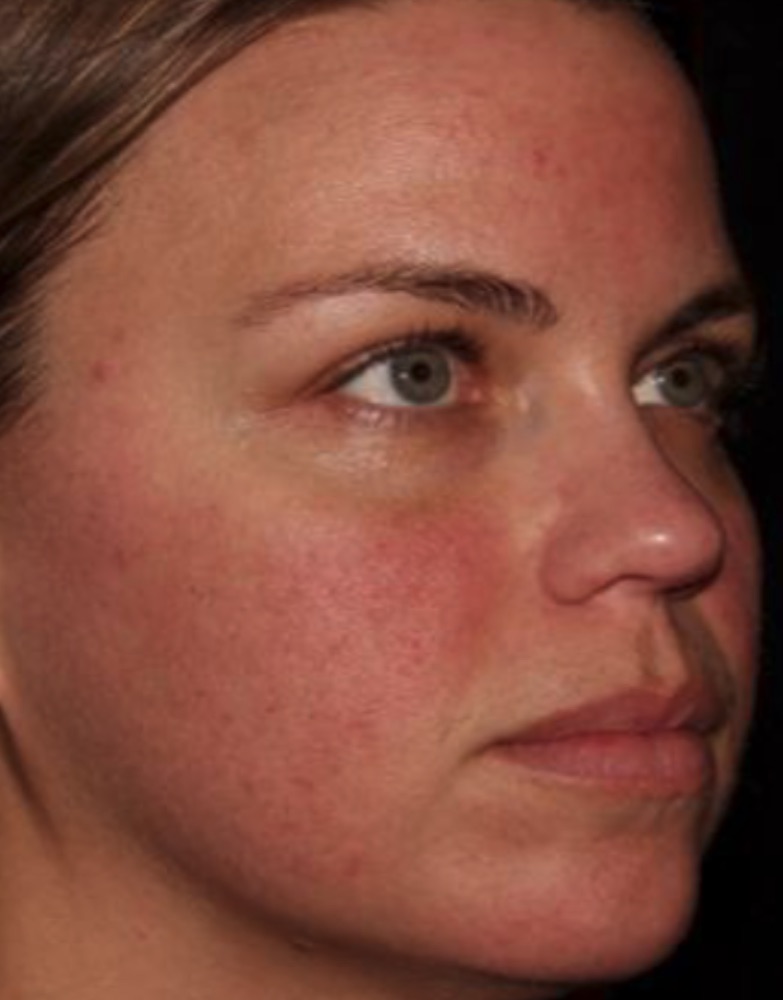 Face one month after two HALO treatments
