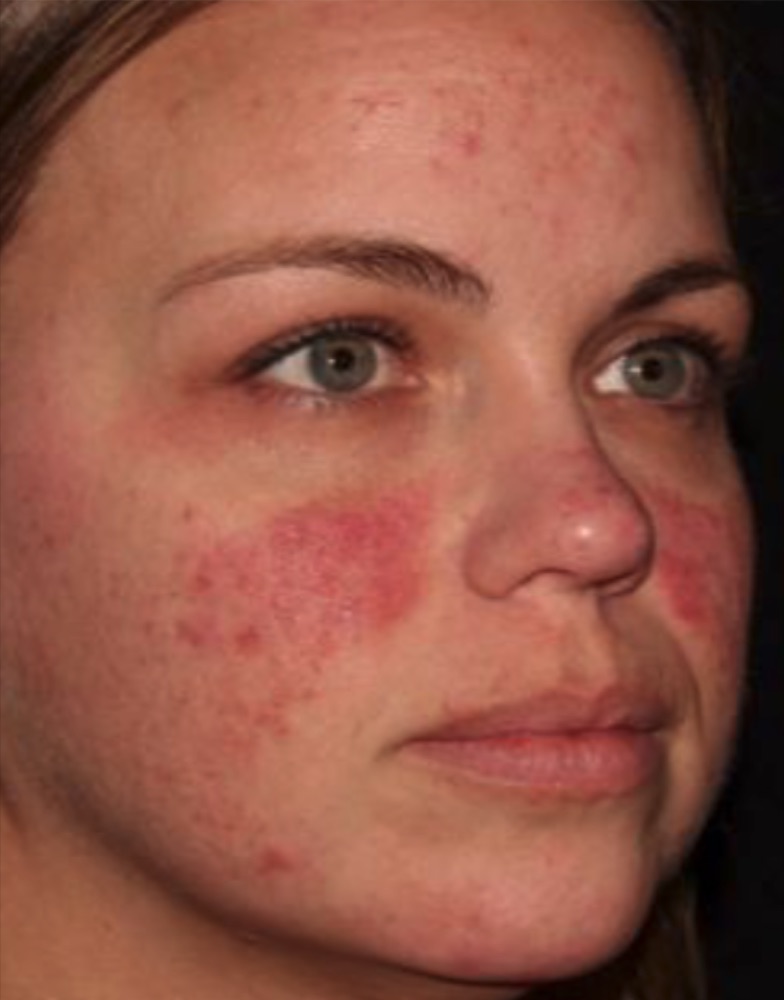 Face before HALO treatment