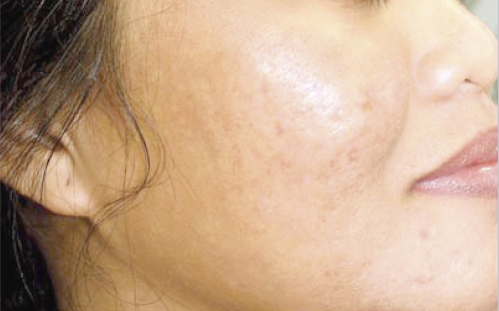 Skin after three ProFractional treatments, with scarring reduced