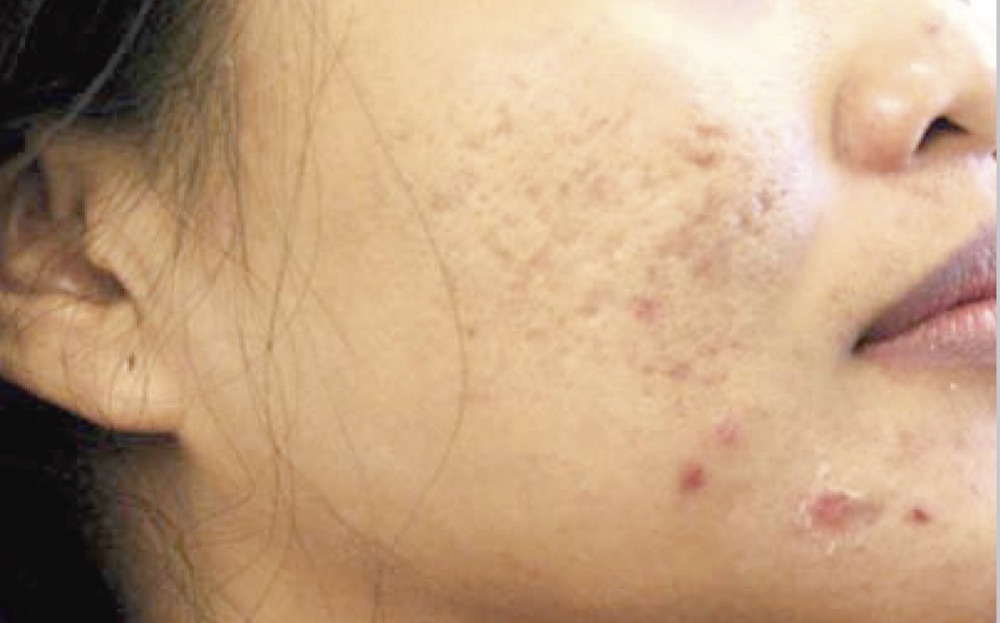 Skin with acne scarring before ProFractional treatment