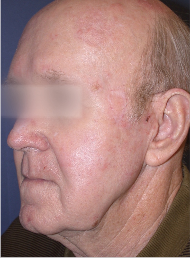 Face three weeks after two ProFractional treatments