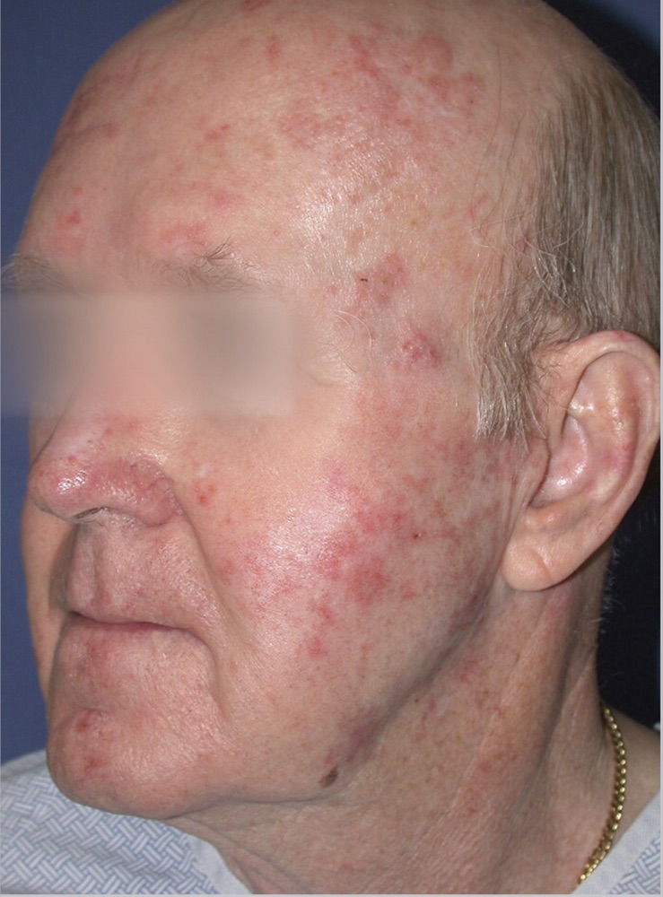 Face before ProFractional treatment